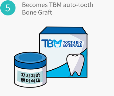 Becomes TBM auto-tooth Bone Graft